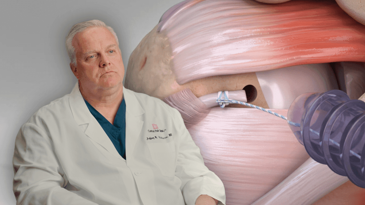 Thumbnail for Shoulder: Biceps Tenodesis