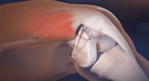 MPFL (Medial Patellofemoral Ligament)