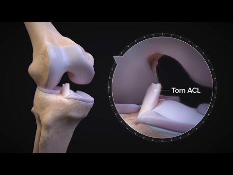 Thumbnail for ACL Injuries FAQs