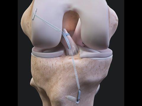 Thumbnail for ACL Repair FAQs